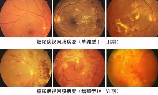 糖尿病引起的眼部并发症有很多，糖尿病视网膜病变(DR)就是其中之一，糖尿病视网膜病变是糖尿病在眼部的一种严重并发症，它对视力有很大危害，如不及时医治，可能造成失明。症状包括视力模糊、阴影、斑点及疼痛。.jpg