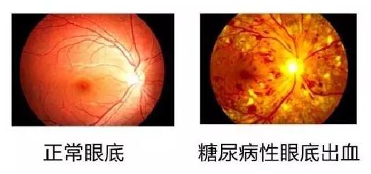  数据表明：糖尿病视网膜病变(简称糖网病)患病率达44%~51.3%，被世界卫生组织认为是仅次于白内障、青光眼的 三致盲眼病。但是不少尤其是基层糖尿病患者，大多数把眼睛的异变误认为是老年人眼花正常现象，从而耽误了病情甚至导致失明。.jpg