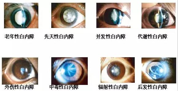 长时间在白色光亮污染环境下工作和生活的人，尤其是长时间接触过强的光线，视网膜和虹膜都会受到程度不同的损害，较终也会伤害晶状体，时间一长，就会使视力下降，使晶状体蛋白发生变性，形成混浊，发展成为白内障1.jpg
