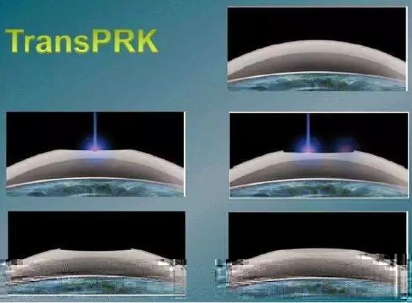 全激光TransPRK手术有其无可比拟的优势，但是 一的缺点就是属于表层手术，术后三天需要配戴隐形眼镜等待上皮愈合，在术后当天以及术后早期眼部会有较飞秒较重的不适感， 时间稍慢，一般需要一周到十天才能逐渐 .jpg