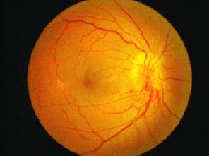 糖尿病除了引起心、脑、肾等全身多脏器损害，也引起多种眼病， 如：糖尿病性视网膜病变、白内障、新生血管性青光眼、视神经病变、葡萄膜炎、眼肌麻痹复视等。所以医生建议糖尿病患者要检查眼底。糖尿病患者应该定期去眼科检查.jpg