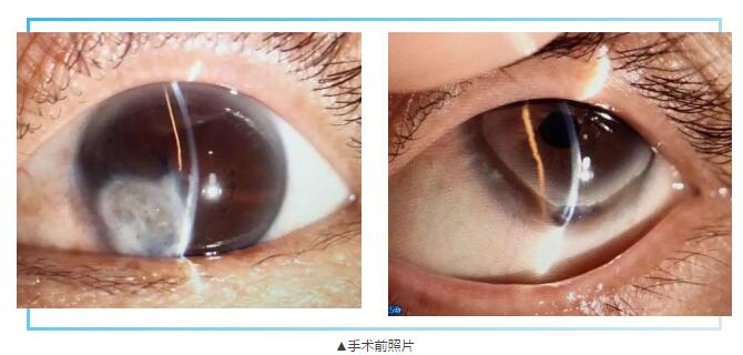 即便天气如此恶劣，合肥名人眼科医院的所有医护人员依然兢兢业业的守护在自己的岗位上。其中有两位患者分别来自安徽的蒙城和涡阳，一 角膜愈着性白斑，致虹膜前后黏连，视力仅有手动。另一 角膜严重边缘变性致穿孔，急需通过角膜移植手术保住眼球。2.jpg