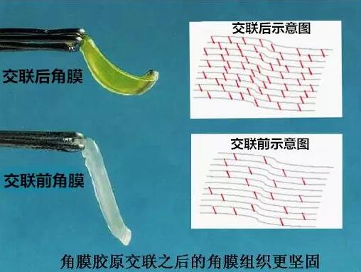角膜胶原交联(Corneal Cross Linking，CCL)医治：使用370纳米波长的紫外线，激活核黄素(一种光敏感剂)，使其转化成活性氧族，活性氧族再诱导角膜胶原纤维的氨基之间发生化学交联反应，使角膜胶原纤维直径增粗、提*角膜基质对多种降解酶作用的抵抗力等多重生物学效应，从而使角膜基质的机械强度增加2.jpg