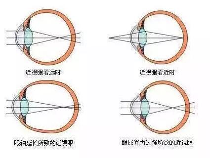 “小孩视力以前挺好的，没想到一个寒假下来就近视了。”昨天的8868在线官网登录平台 - 8868网页版登录小儿眼科门诊里，很多家长都反应说，“孩子期末成绩不错，所以假期里对他的管束放松了，一有空就拿起手机玩。直到前几天，他嚷着看东西变模糊了，才带孩子来医院检查，检查结果是左右眼出现不同程度的近视，医生建议配戴眼镜。.jpg