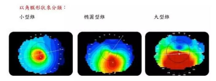 圆锥角膜是一种角膜扩张性疾病，患病后角膜中央或偏中央区域会发生局部变薄向外扩张，导致散光，并随着病情进展逐渐出现视力下降、 不良、视物扭曲变形、虹视等，极大影响生活，严重者可致盲。2.jpg