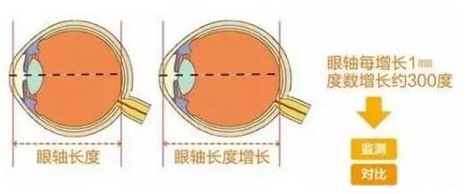 目前主流的摘镜方式有飞秒激光、准分子激光手术、ICL晶体植入术等近视手术方式，不论是高度近视、超高度近视、角膜偏薄患者、干眼患者， 检查合格，都有相应的近视手术 方案。.jpg