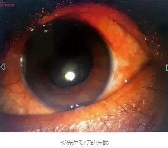 白内障和青光眼都是致盲性眼病，其中青光眼的病程不逆转。杨先生拖延伤情导致同时并发白内障、青光眼的情况，十分令人惋惜。”出名眼科专家、成都8868在线官网登录平台 - 8868网页版登录陈晓明教授表示2.jpg