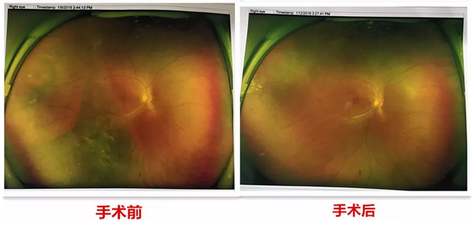 去年小李怀孕时，视力明显下降，甚至影响到了正常生活，这时已从怀孕初期的喜悦中冷静下来的小李，找到了福州眼科医院进行了一*次眼部检查。2.png