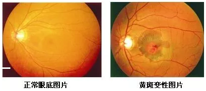 黄斑位于人眼底视网膜的中央，是视力 敏锐的部位，一般医生在测视力时，就是在检查黄斑区的视觉能力。当黄斑区出现异常时，也就是黄斑病变，人的中心视力就会变模糊、变扭曲。.png