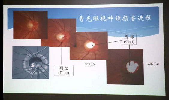 3月10日上午，深圳8868在线官网登录平台 - 8868网页版登录“早查监控，守护光明”大型青光眼公益科普讲座在六楼 举行，本次活动旨在让更多人了解青光眼的潜在危害、重视眼检查， 预防青光眼。由深圳8868在线官网登录平台 - 8868网页版登录青光眼病科 席专家成洪波博士、傅培副院长现场面对面解答疑问，与参会者的互动交流，让更多深圳市民提*对青光眼的认识与防治知识3.png