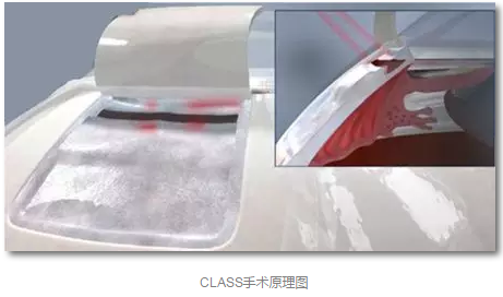 成都8868在线官网登录平台 - 8868网页版登录已经开展的青光眼手术有：引流阀 (钉)植入手术(2015年以来已200多 )，360°Schlemm's管切开术，激光CO2 辅助巩膜深层切除术，小梁切除术青(光眼)白(内障)联合手术。还有虹膜周切术、前房成形术、 虹膜复位术，睫状体冷冻术，小梁切开术和前房穿刺术等4.png