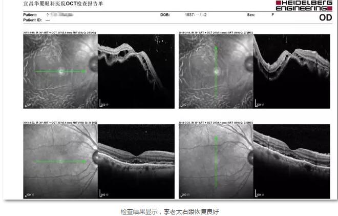 李老太在毫无征兆的情况下右眼视力下降至看不见东西。李老太家人带其至县医院就诊。医生诊断为视网膜脱离，需做玻切手术医治，而玻切手术需要动手术2次。怕疼的李老太一听就犯怵了：开刀，疼。 终，李老太的家人在多方打听后决定带李老太至宜昌8868在线官网登录平台 - 8868网页版登录找许大玲院长医治4.jpg