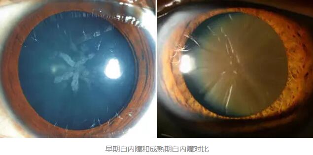 白内障超声乳化术是如今新式微创白内障手术，它创伤小、愈合快，术后 二天 正常生活。老年人能不能承受得住白内障手术呢2.jpg