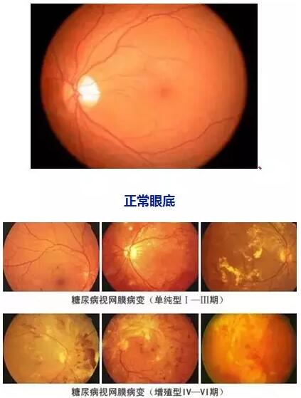 4月14日(本周六)福州眼科医院将举办“常见老年人眼底病”公益讲座，由医院副院长、眼底病科何建忠主任主讲，为大家解读各类眼底疾病的预防和诊治知识1.jpg