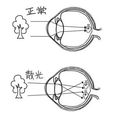 近视加散光想要 ，飞秒全激光近视手术是很好的选择。 一*次近视激光手术，就可以同时 近视、合并散光。1.jpg