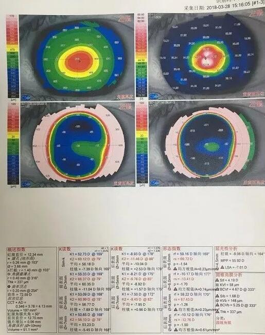 角膜移植是利用异体的正常透明角膜组织，取代浑浊病变的角膜组织，使患者复明或控制角膜病变，这在目前同种器官移植当中， 率是 高的，也是重要的复明手术之一。”在 为一位饱受圆锥角膜之苦患者 实施角膜移植之后，卢敏院长也对患者极为关心的角膜移植相关知识进行介绍。比如哪些患者适合角膜移植手术