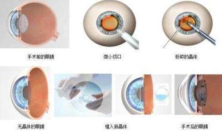 三焦点人工晶体手术原理：置换掉人眼老去的晶体，世代的晶体不仅有非常好的弹性，以往传统的白内障手术只是单纯的脱盲复明手术，更多的是解决患者 远视力。而三焦点人工晶体的问世，彻*解决了传统白内障术后仍需配镜的问题，实现了从以往‘看得见’到‘看得清、看得好’的转变.jpg