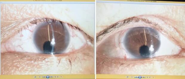 先天性虹膜脉络膜缺损的白内障患者在厦门眼科中心白内障超乳手术后视觉满意2.jpg