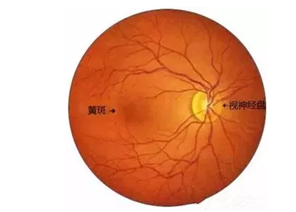 老年黄斑变性其实是眼部黄斑区结构的衰老性改变引起的眼病。“黄斑”是位于视网膜核心区的一个生理结构，一旦黄斑区的视神经细胞被破坏，就会引起患者中心视力下降、视物变形、色暗等1.png