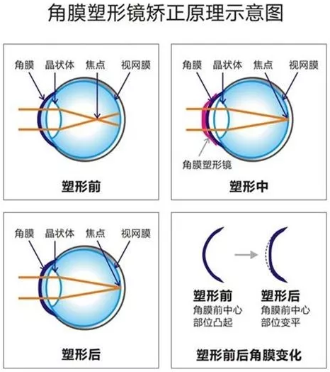 角膜塑形镜是一种硬性透气性隐形眼镜，戴在眼表可使角膜发生塑形效应，从而达到 近视度数的 。适合夜晚睡觉时配戴，白天不用戴眼镜就可以 裸眼视力，不影响学习、运动.png