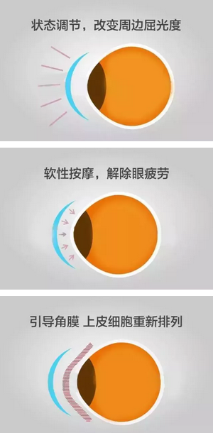 角膜塑形镜是一种硬性透气性隐形眼镜，戴在眼表可使角膜发生塑形效应，从而达到 近视度数的 。适合夜晚睡觉时配戴，白天不用戴眼镜就可以 裸眼视力，不影响学习、运动2.png