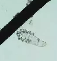 眼部瘙痒、干涩泛红、异物感，可能不是干眼症而是蠕形螨性睑缘炎.png