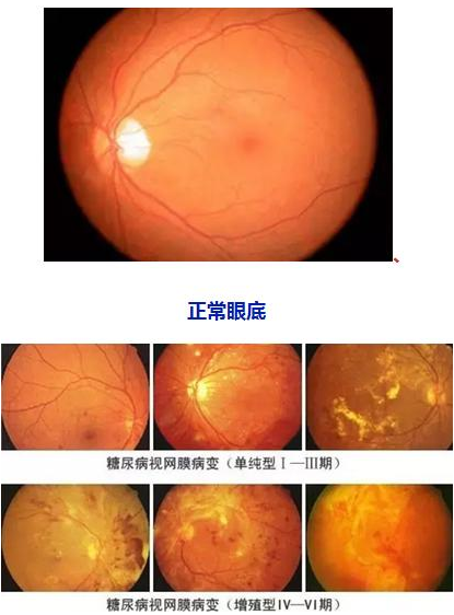 糖网病的症状和防治方式.png