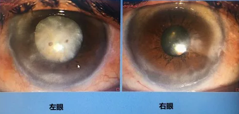 同时患 青光眼、白内障老婆婆辗转几家医院之后终于在成都8868登录平台顺利手术2.png