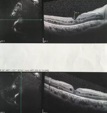 葡萄膜炎等多种眼底病患者跪地感谢深圳8868在线官网登录平台 - 8868网页版登录院长赵铁英教授2.png