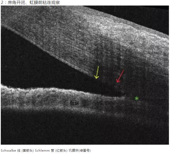 8868登录平台课堂：后节频域OCT前节模块的运用12.jpg