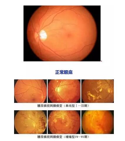 因糖网病几近失明在福州眼科医院进行微创玻切、白内障超乳术后顺利复明2.jpg