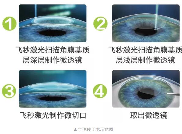 主流近视手术包含全飞秒激光手术、Smart全激光手术、半飞秒激光手术、晶体植入手术1.jpg