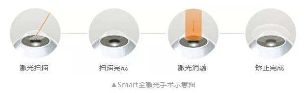主流近视手术包含全飞秒激光手术、Smart全激光手术、半飞秒激光手术、晶体植入手术2.jpg