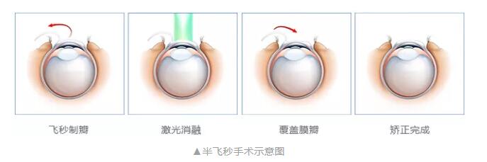 主流近视手术包含全飞秒激光手术、Smart全激光手术、半飞秒激光手术、晶体植入手术3.jpg