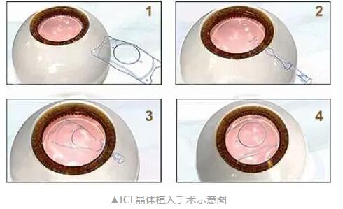 主流近视手术包含全飞秒激光手术、Smart全激光手术、半飞秒激光手术、晶体植入手术4.jpg
