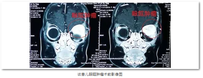 8868在线官网登录平台 - 8868网页版登录斜视与小儿眼科主任苏金萍顺利为新生儿摘除眼眶巨大肿瘤1.png