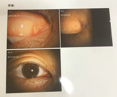 成都8868登录平台罗清礼院长为四处求医未果的河南眼眶肿瘤患者手术2.png
