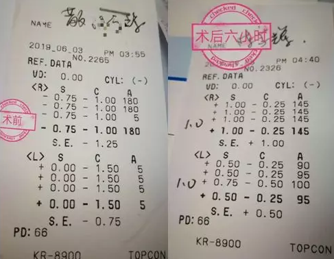福州眼科医院近视手术取样：视力不差、无法通过参军公考体检群体该怎么办1.png