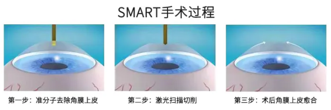 高考毕业后做近视手术，如今近视手术有了越来越高的安全性，且多样的术式可以满足不同患者的摘镜需求。2.png